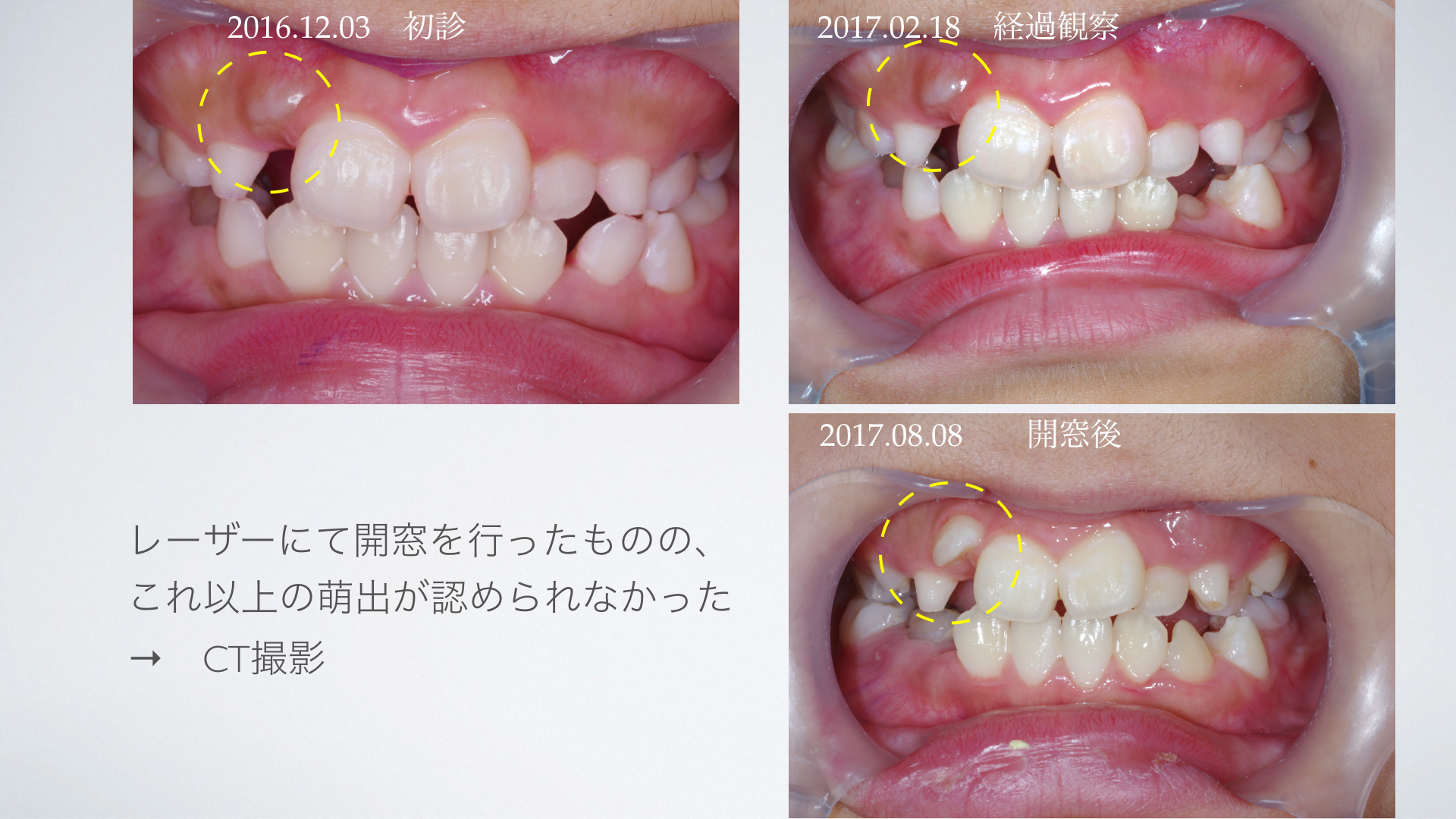 上顎側切歯と犬歯の埋伏に外科的挺出を行い、本格矯正治療を行った一例