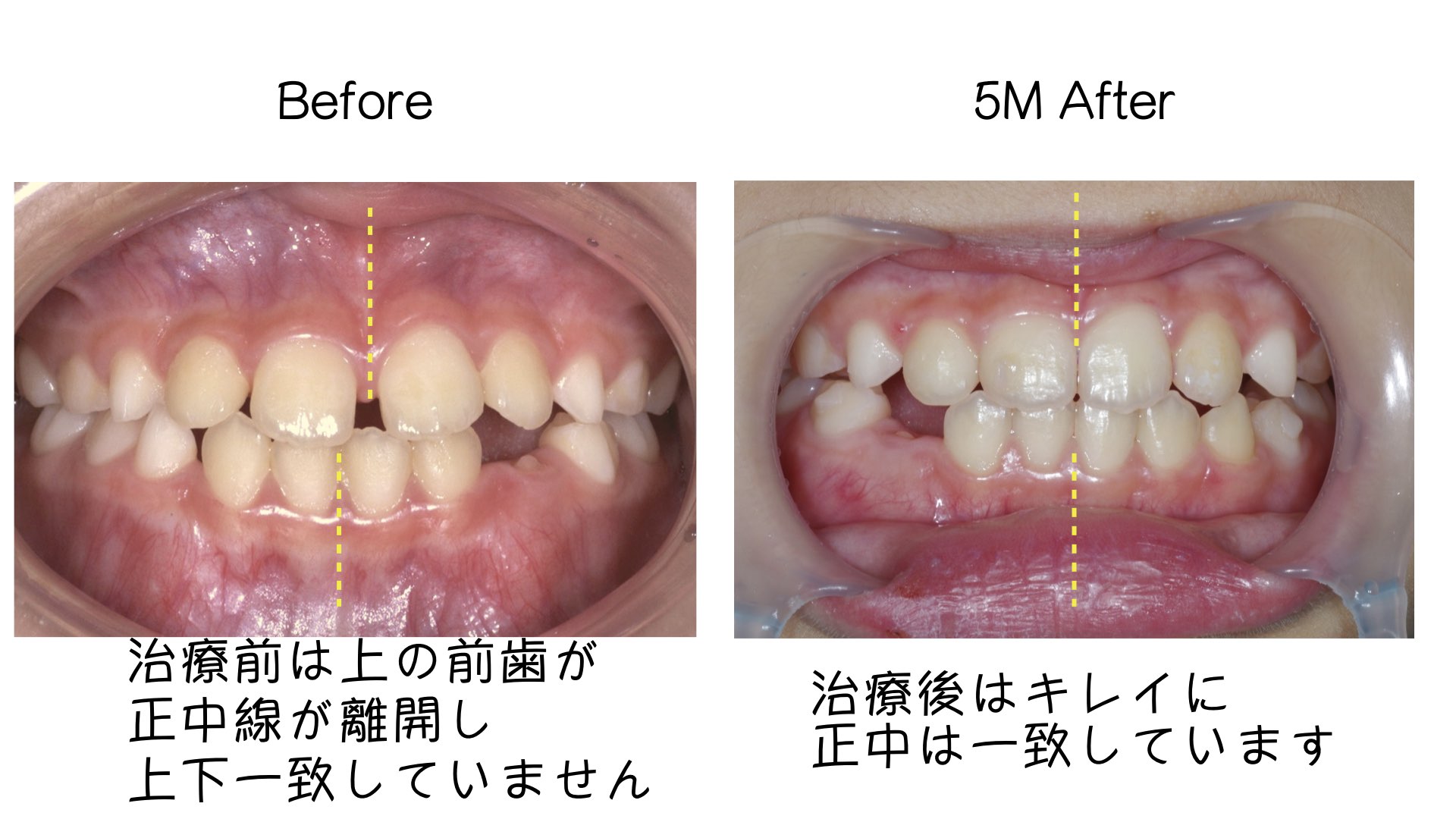 小学生の時期ならではのアプローチ「インビザライン・ファースト」