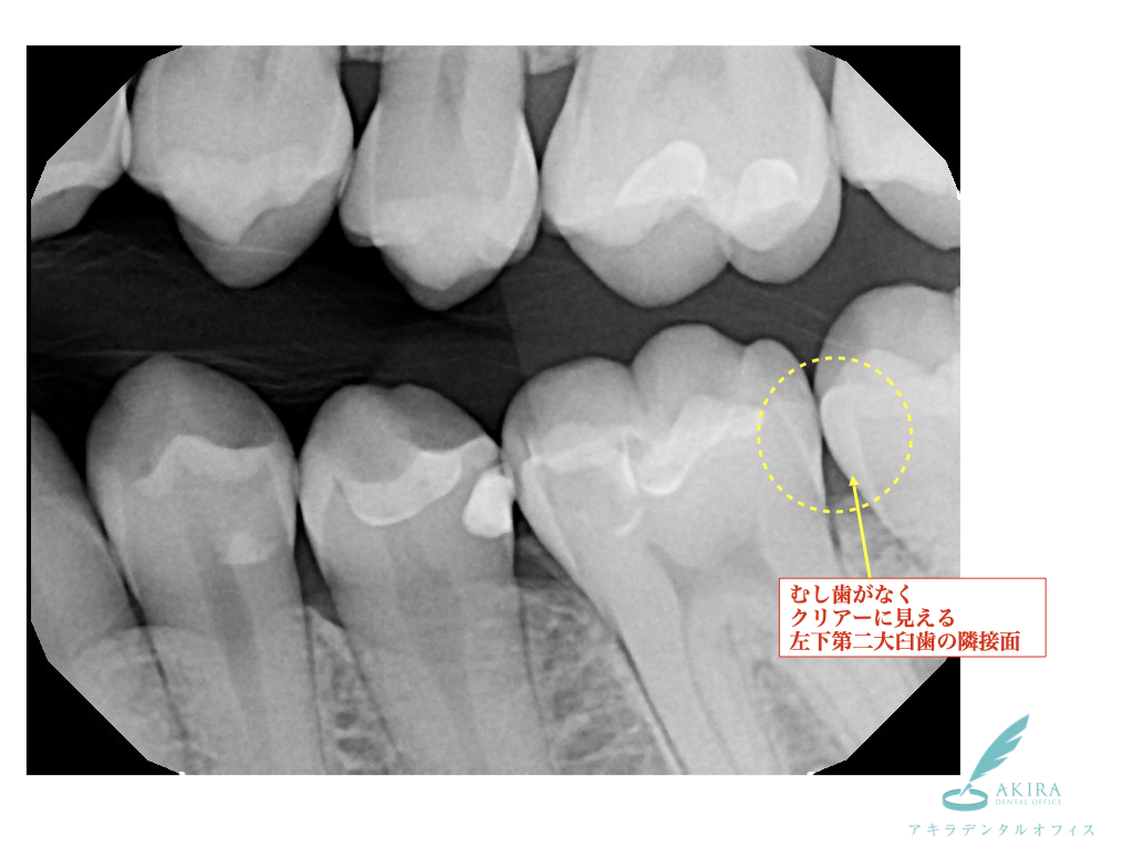 口腔内スキャンiTero5D（アイテロファイブディー）のNIRI（近赤外線）撮影によるむし歯の診査