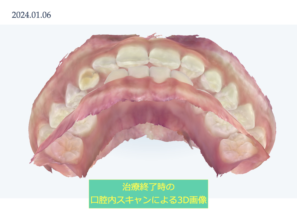 実際のインビザライン　前歯の交叉する咬み合わせ・下顎前歯2本の欠損　