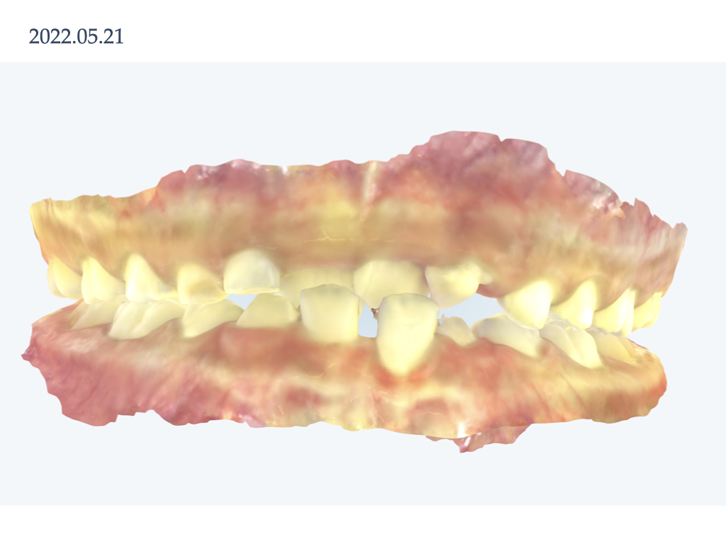 実際のインビザライン　前歯の交叉する咬み合わせ・下顎前歯2本の欠損　