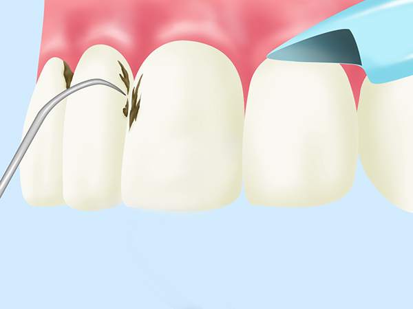歯石除去（歯のクリーニング）