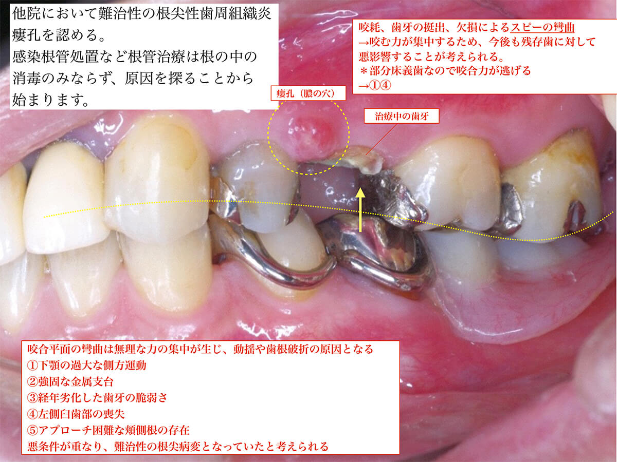 歯科用顕微鏡およびCBCT撮影を用い歯の根管治療を行った