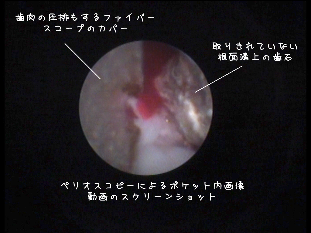 ペリオスコピー　〜ファイバースコープで歯周ポケット内を確認する治療（保険診療）〜