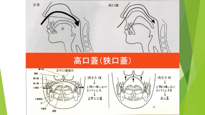 指しゃぶり　と　口腔筋機能療法（MFT）