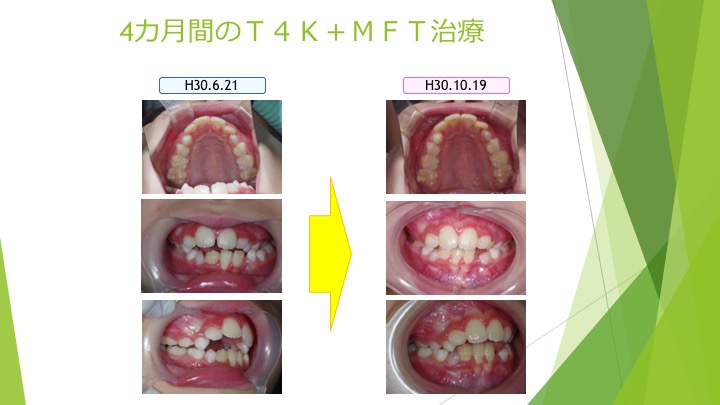 指しゃぶり　と　口腔筋機能療法（MFT）