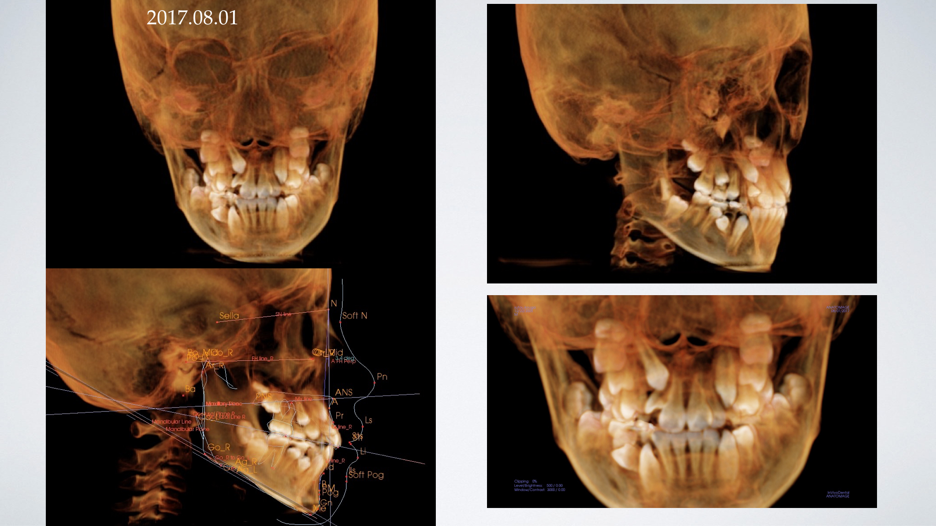 上顎側切歯と犬歯の埋伏に外科的挺出を行い、本格矯正治療を行った一例