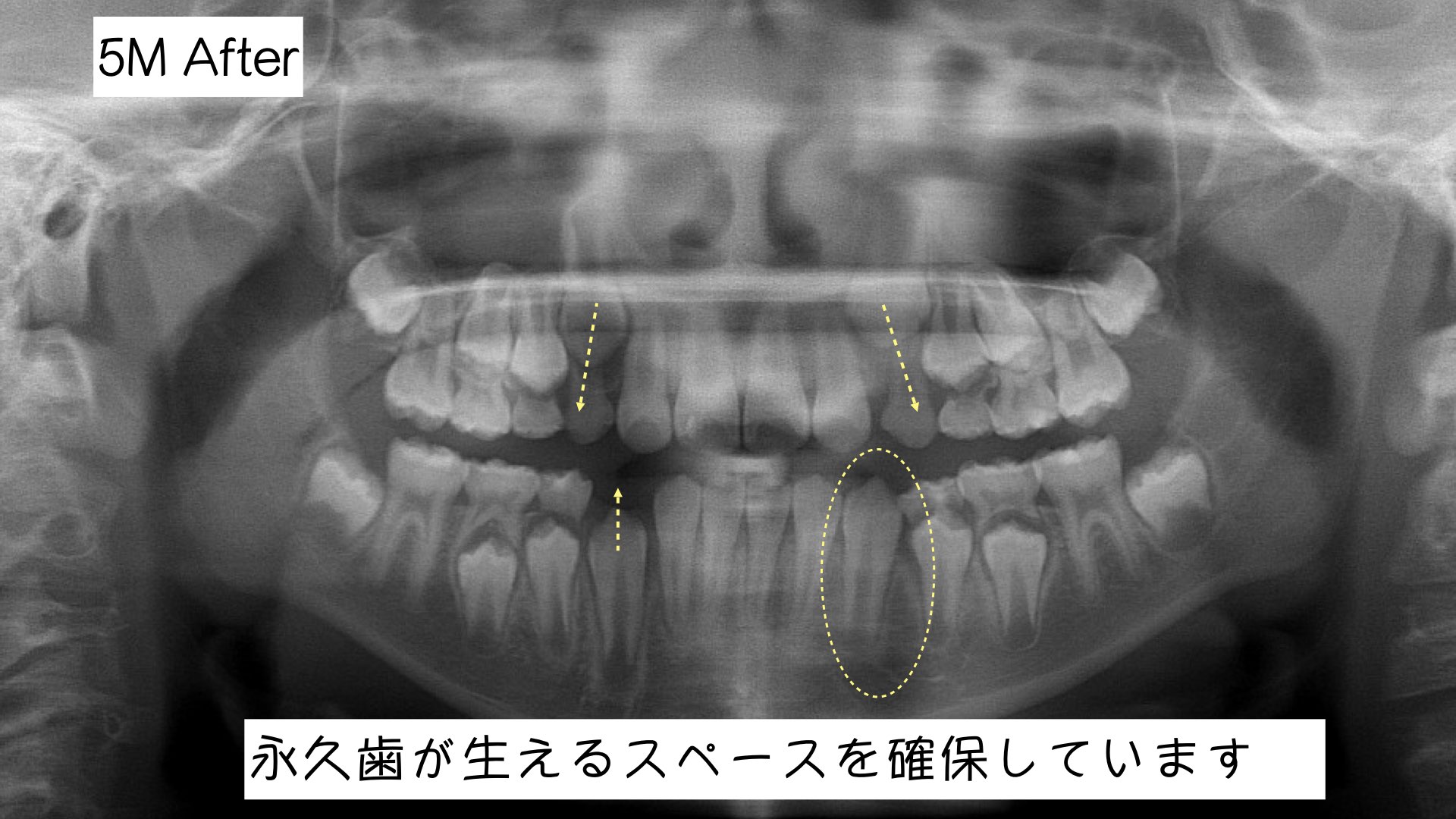 小学生の時期ならではのアプローチ「インビザライン・ファースト」