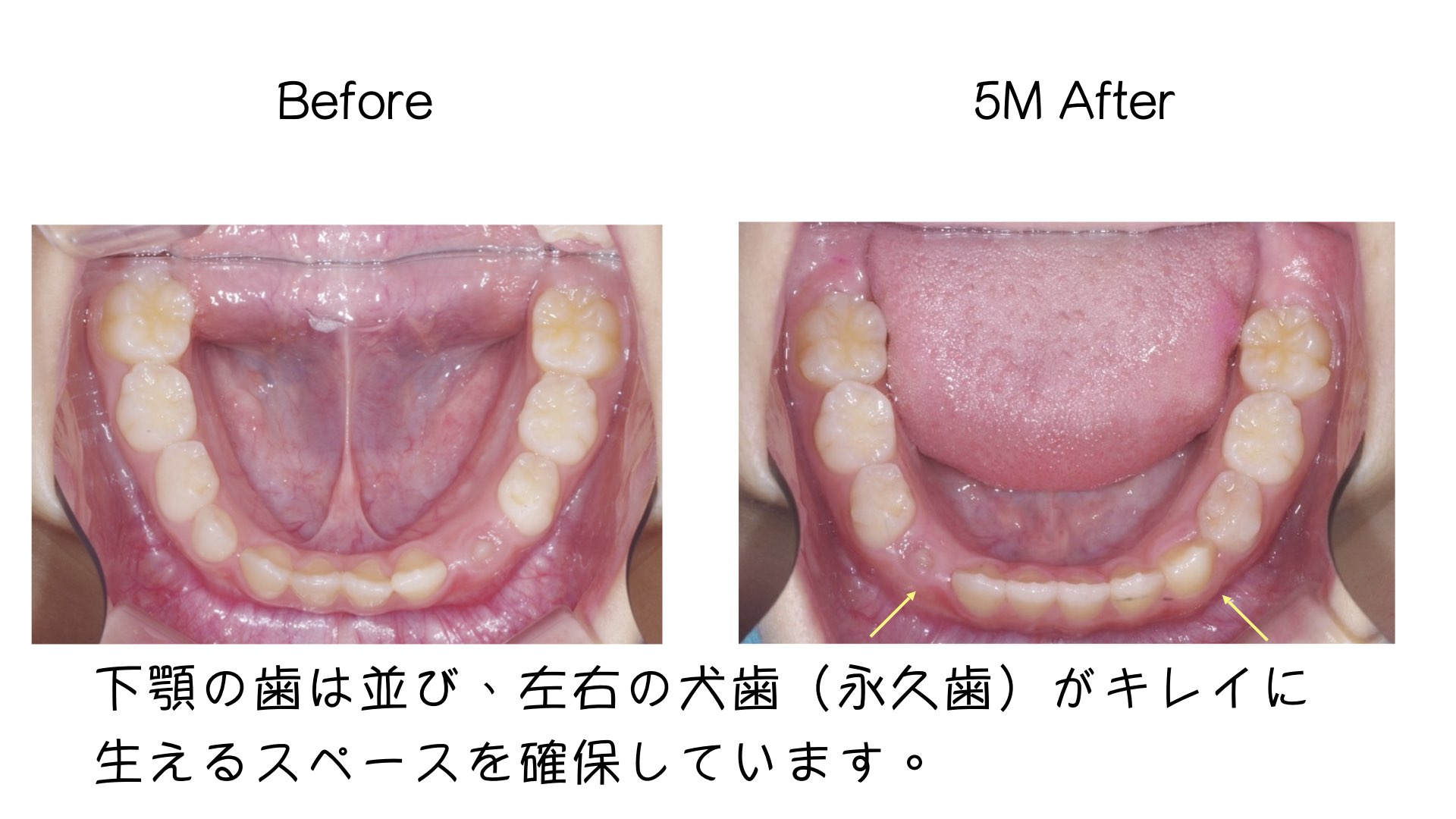 小学生の時期ならではのアプローチ「インビザライン・ファースト」