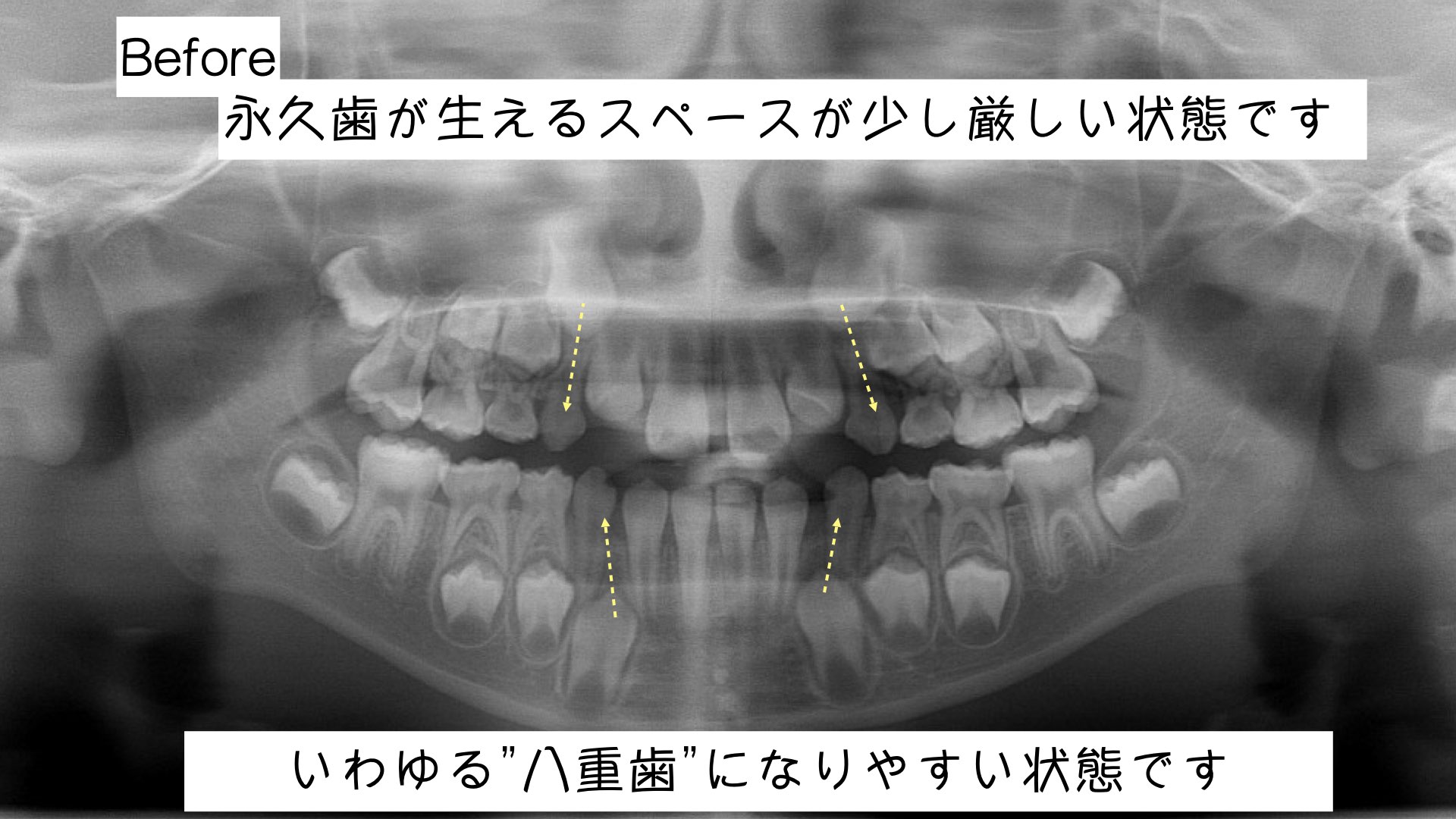 小学生の時期ならではのアプローチ「インビザライン・ファースト」