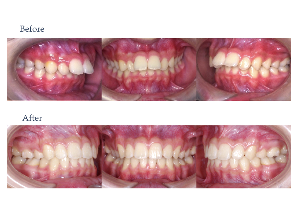 歯並びを治す本格矯正治療（自由診療）