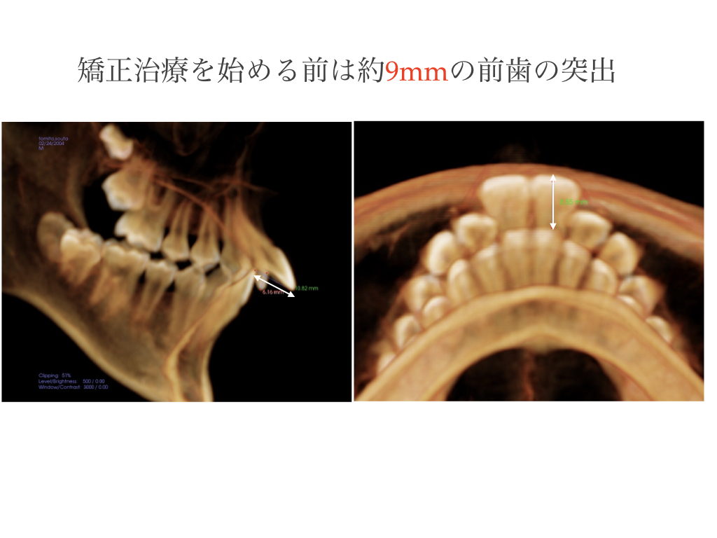 歯並びを治す本格矯正治療（自由診療）