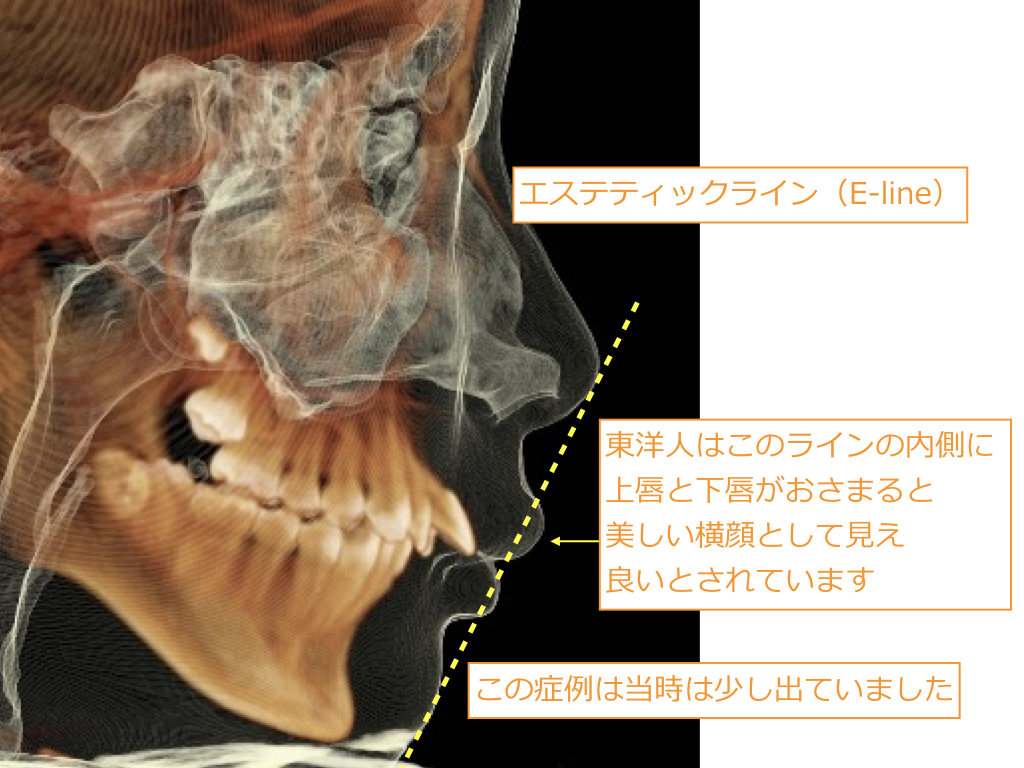 歯並びを治す本格矯正治療（自由診療）