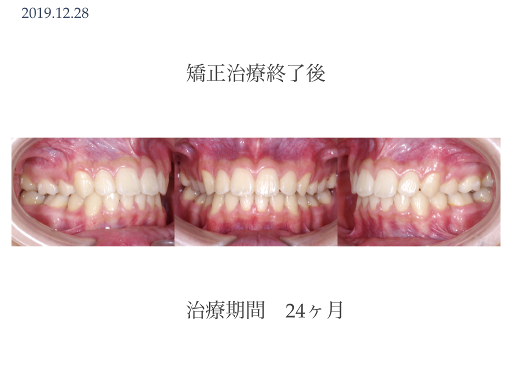 歯並びを治す本格矯正治療（自由診療）