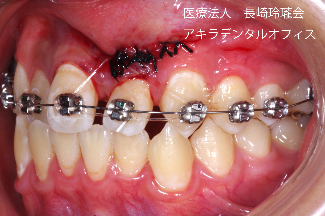 埋伏している歯を引っ張りだして歯並びを良くします（矯正治療）