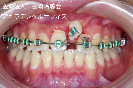 埋伏している歯を引っ張りだして歯並びを良くします（矯正治療）