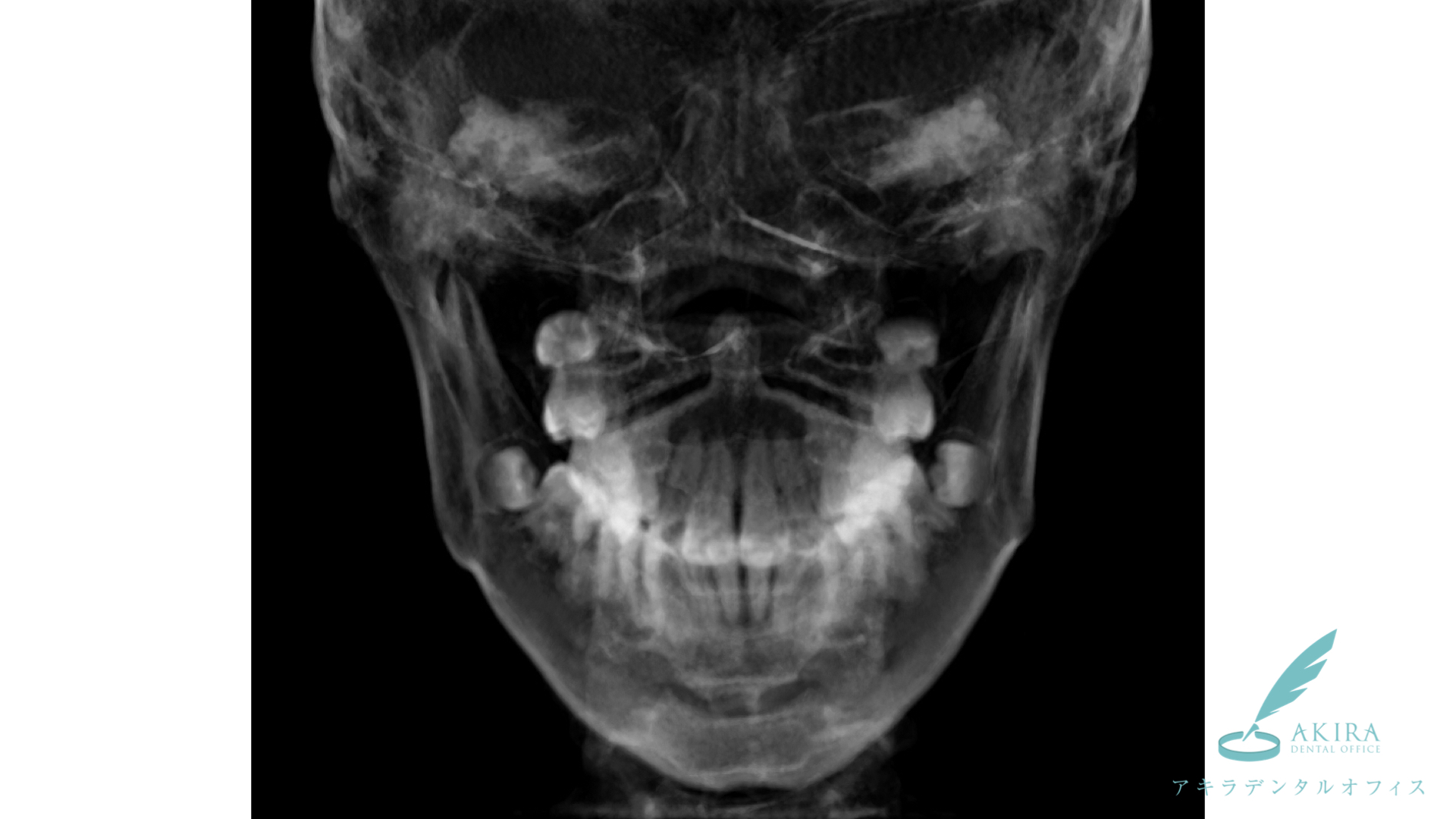 歯並びについて幼稚園から小学校の時にはパノラマエックス線撮影やセファロ CT撮影で確認した方が良いでしょう