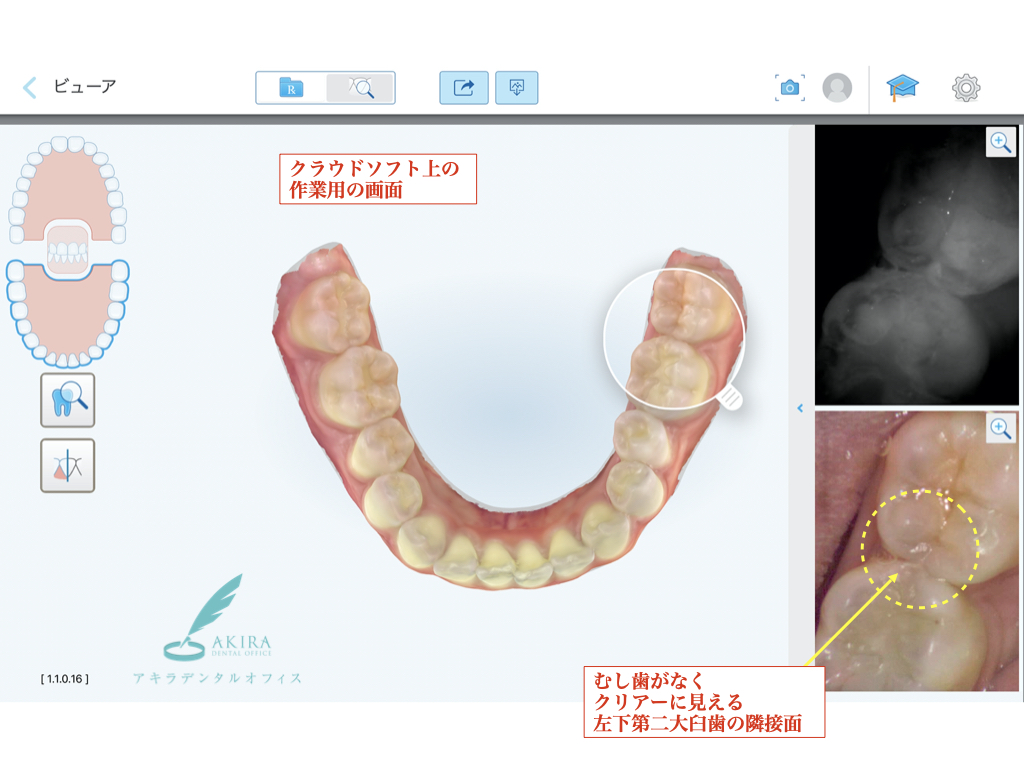口腔内スキャンiTero5D（アイテロファイブディー）のNIRI（近赤外線）撮影によるむし歯の診査