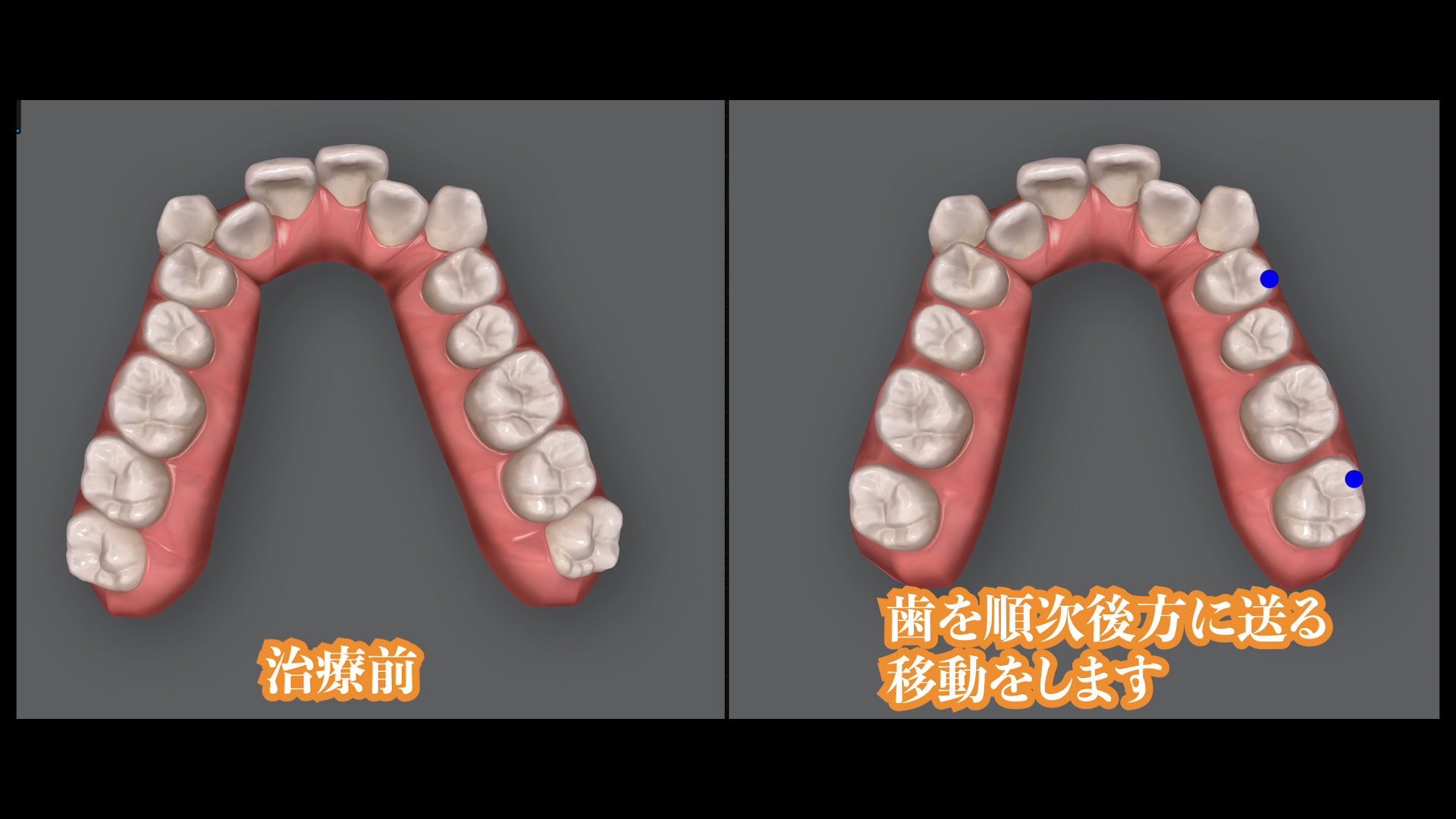 歯を抜かない矯正治療パターン（インビザライン ）について