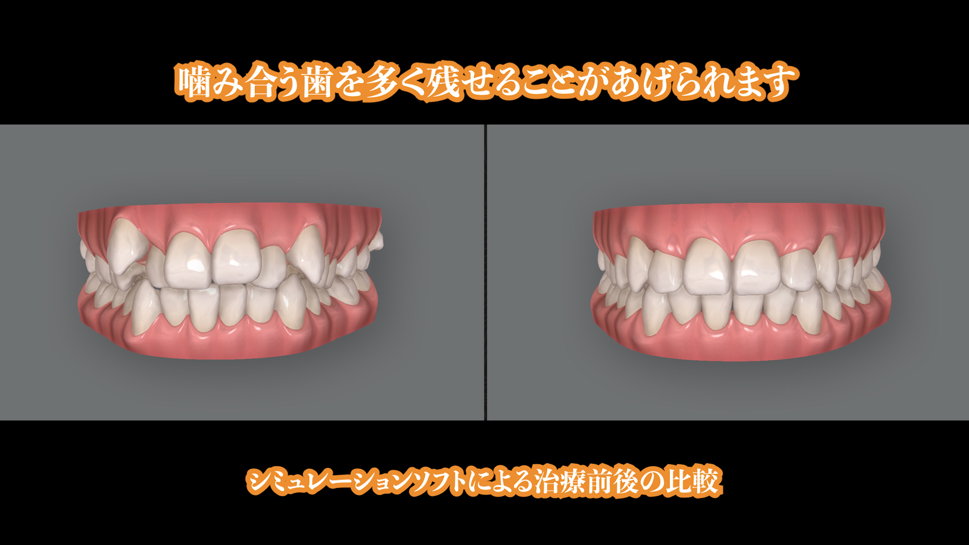 歯を抜かない矯正治療パターン（インビザライン ）について