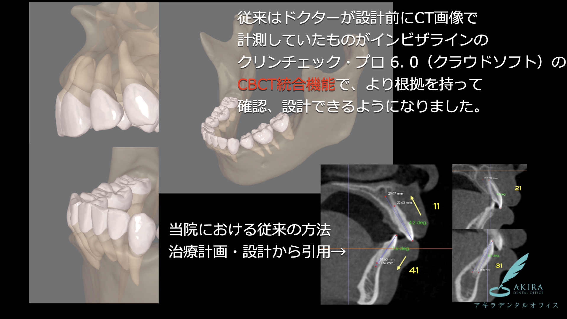 インビザラインの進化　CBCT統合機能　