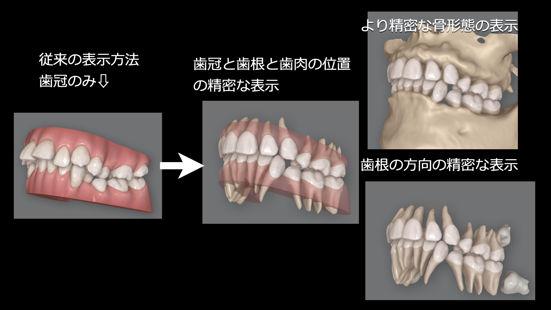 インビザラインの進化　CBCT統合機能　