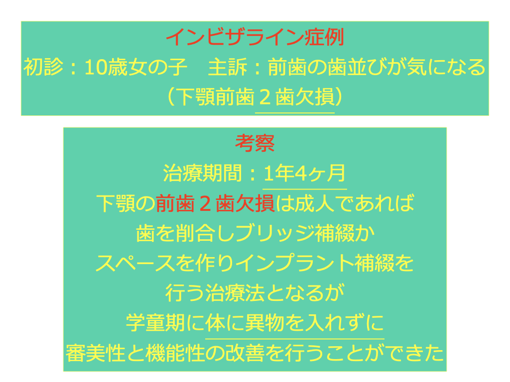 実際のインビザライン　前歯の交叉する咬み合わせ・下顎前歯2本の欠損　