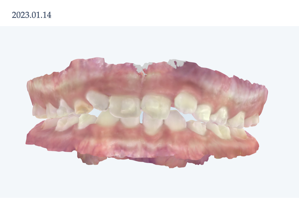 実際のインビザライン　前歯の交叉する咬み合わせ・下顎前歯2本の欠損　