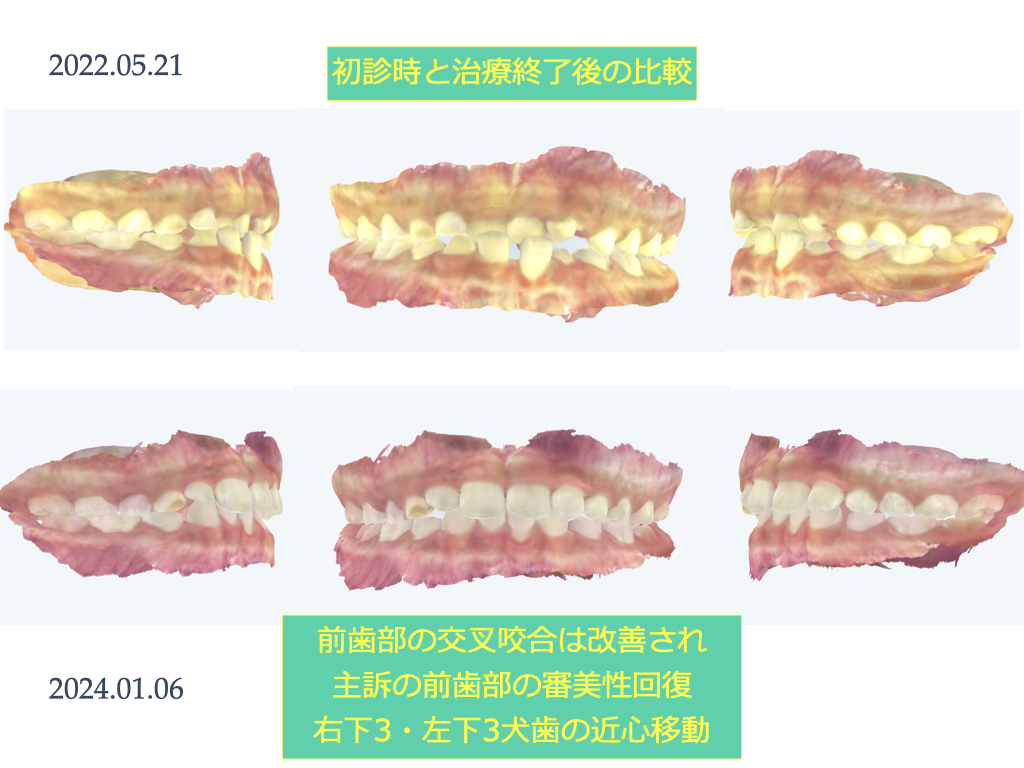 実際のインビザライン　前歯の交叉する咬み合わせ・下顎前歯2本の欠損　