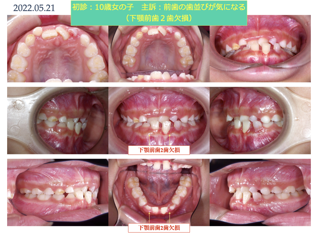 実際のインビザライン　前歯の交叉する咬み合わせ・下顎前歯2本の欠損　