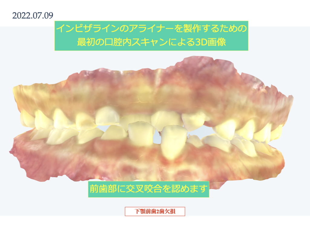 実際のインビザライン　前歯の交叉する咬み合わせ・下顎前歯2本の欠損　