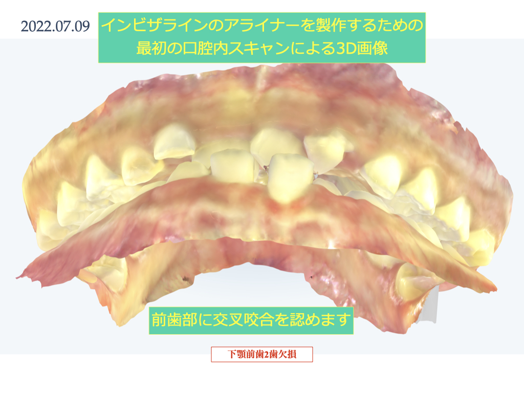 実際のインビザライン　前歯の交叉する咬み合わせ・下顎前歯2本の欠損　