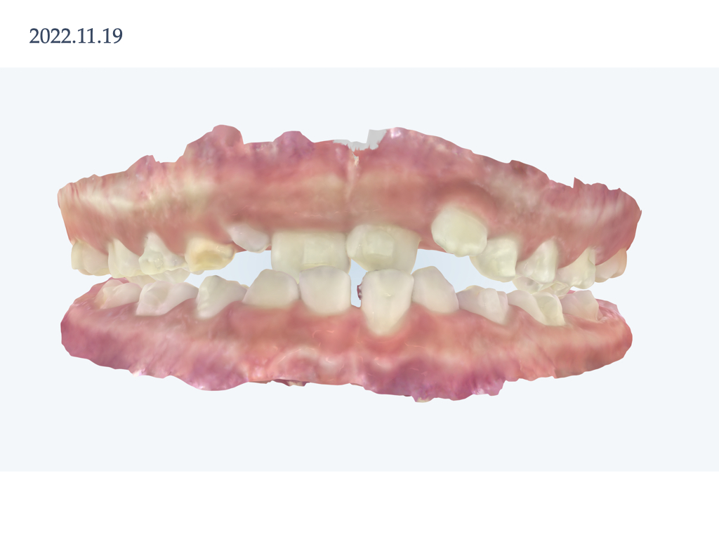 実際のインビザライン　前歯の交叉する咬み合わせ・下顎前歯2本の欠損　
