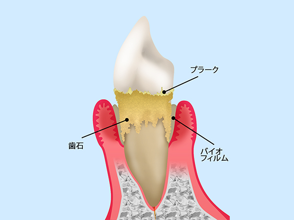 プラークとなって歯に付着し歯石になる