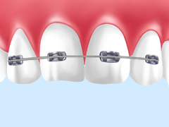部分矯正治療について