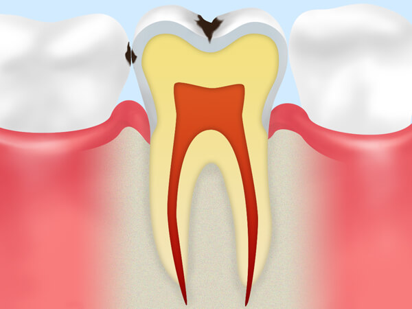 C1：エナメル質内のむし歯