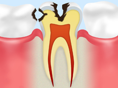 C2：象牙質に達したむし歯