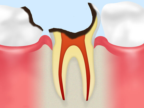 C3：歯髄（神経）に達したむし歯