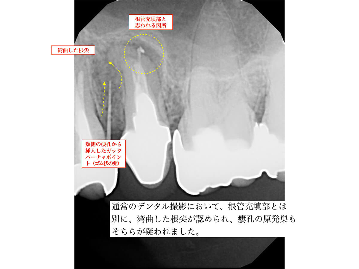 歯科用顕微鏡およびCBCT撮影を用い歯の根管治療を行った