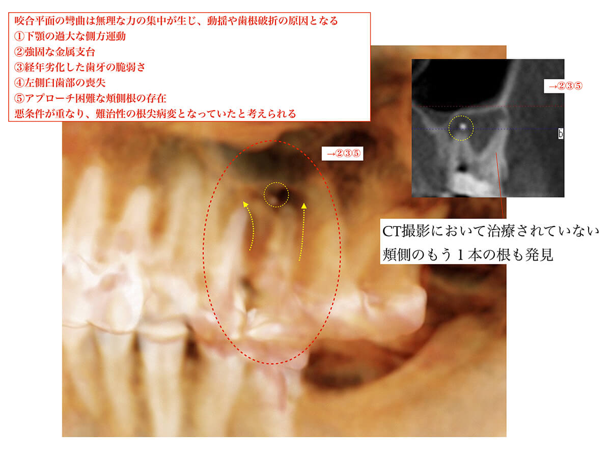 歯科用顕微鏡およびCBCT撮影を用い歯の根管治療を行った
