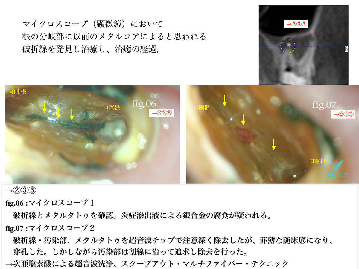 歯科用顕微鏡およびCBCT撮影を用い歯の根管治療を行った